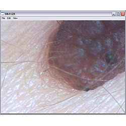 Visin de melanoma con el microscopio PCE-MM 200.