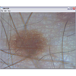 Visualizacin de un lunar con el microscopio PCE-MM 200.