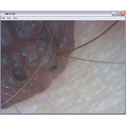 Visin de melanoma con el microscopio PCE-MM 200.